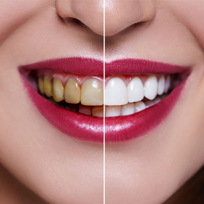 Teeth Comparison